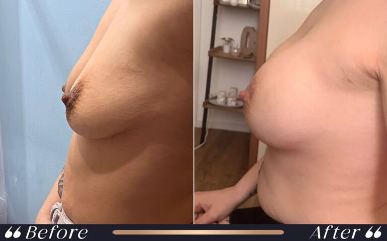 breast_silicon_28