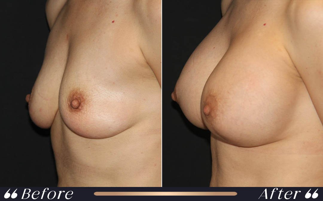 Breast augmentation Turkey cost 2026 at Yeşilköy Clinic Istanbul
