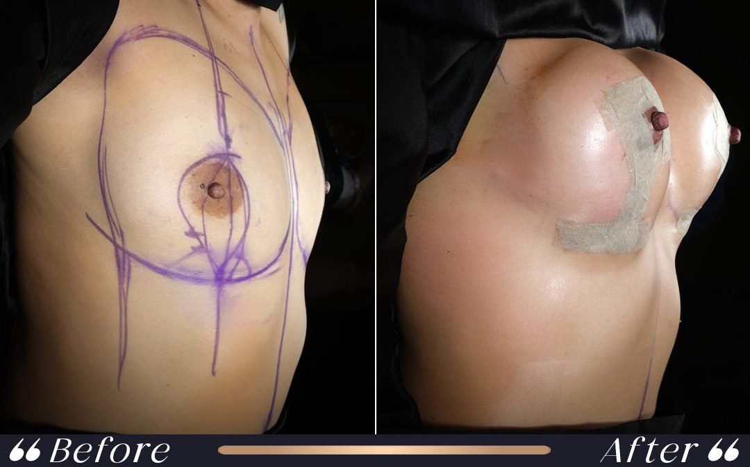 Breast Lift Before and After