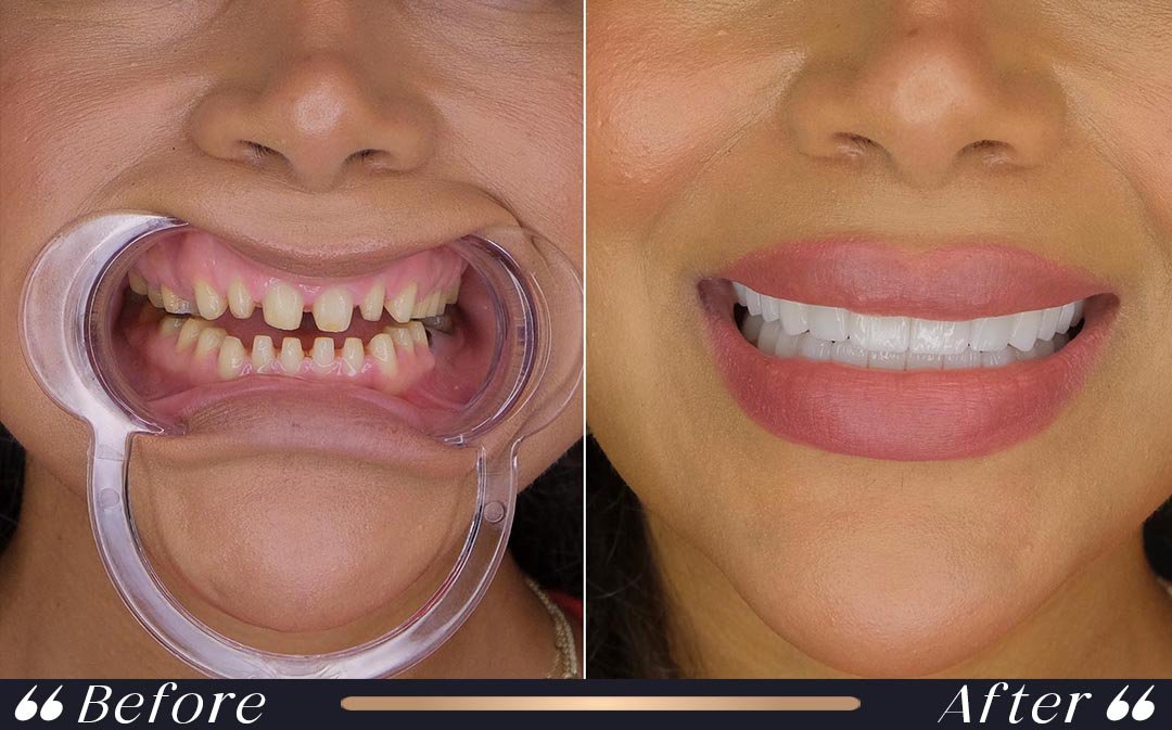 Veneers vs Zirconium Crowns veneers vs zirconium crowns comparison at Yesilkoy Clinic