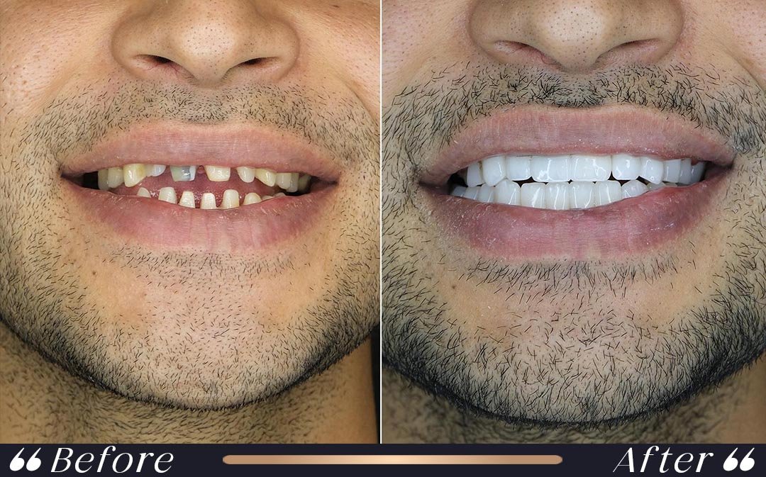 Dental Veneers at Yesilkoy Clinic