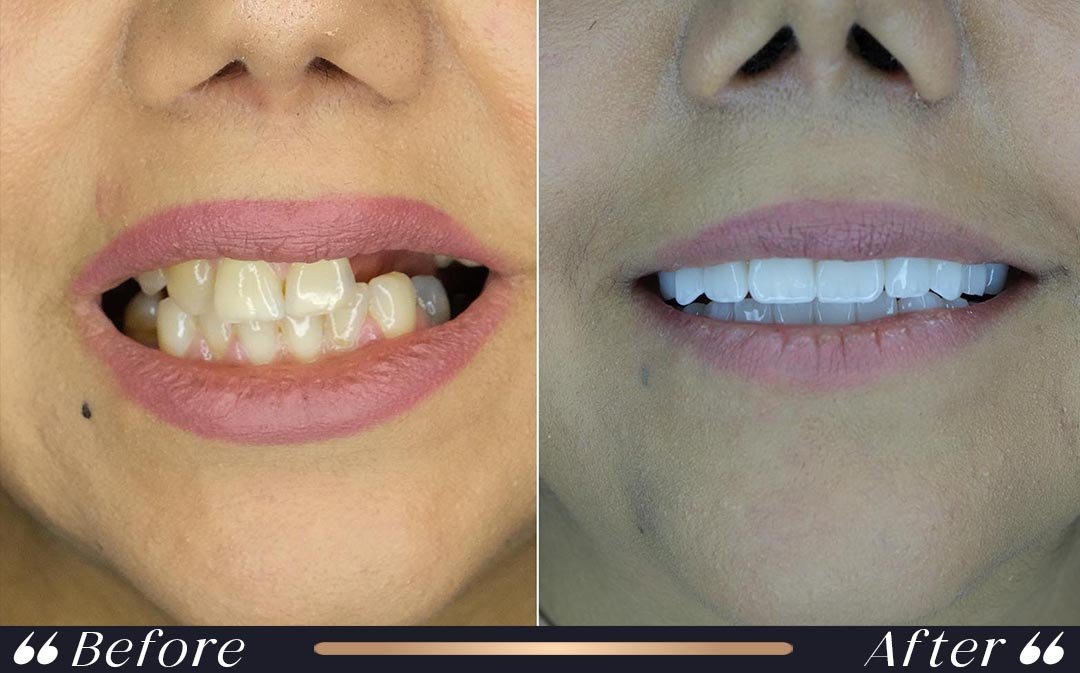 Hollywood Smile at Yesilkoy Clinic