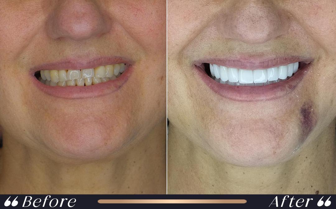 Dental Veneers at Yesilkoy Clinic