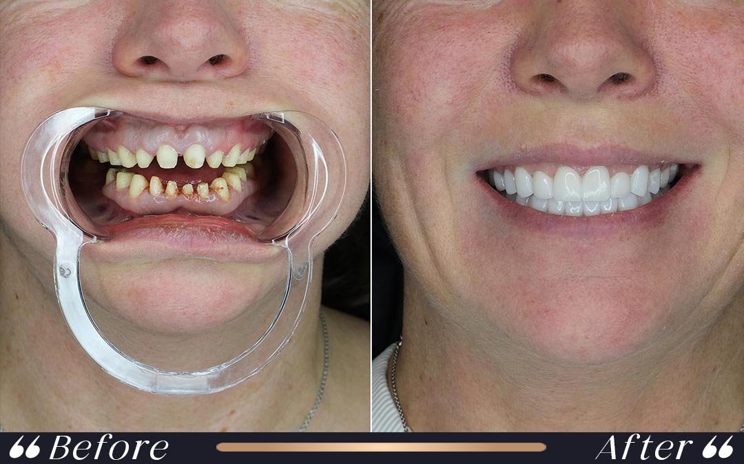 Dental Implants at Yesilkoy Clinic