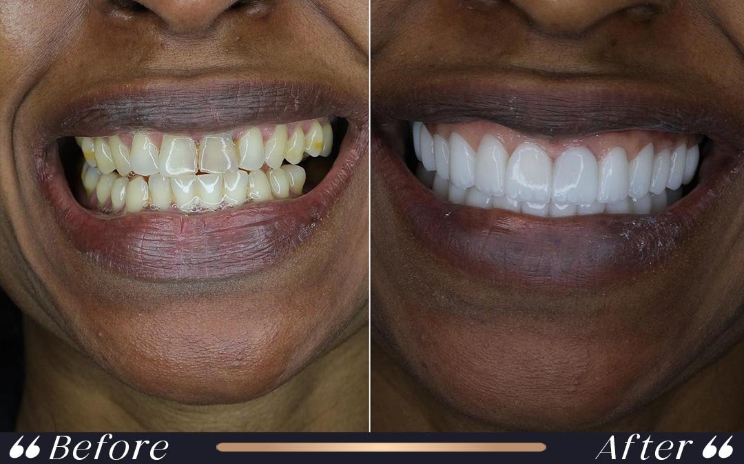 Dental Implants at Yesilkoy Clinic