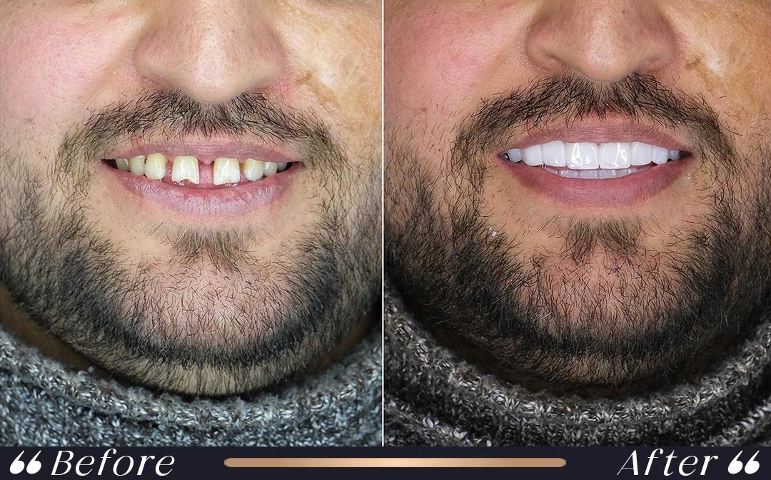 Dental Crowns at Yesilkoy Clinic