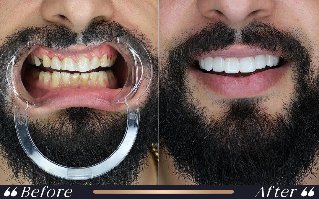 Dental Veneers at Yesilkoy Clinic