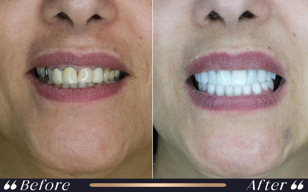 Hollywood Smile at Yesilkoy Clinic