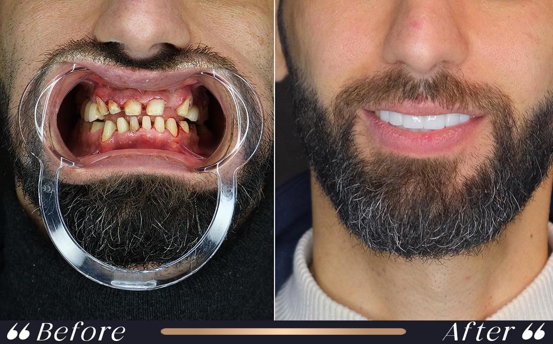 Dental Veneers dental veneers in veneers vs zirconium crowns comparison