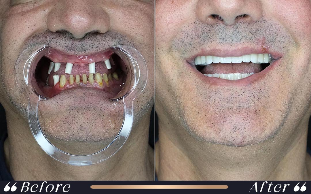 Hollywood Smile at Yesilkoy Clinic
