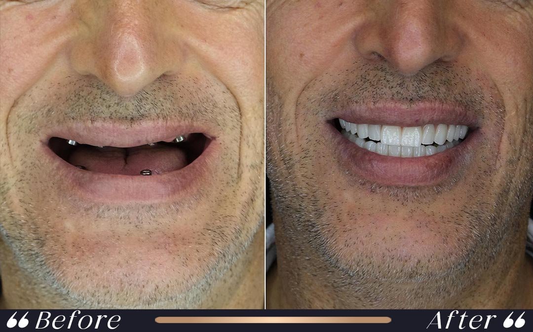 Dental Crowns at Yesilkoy Clinic