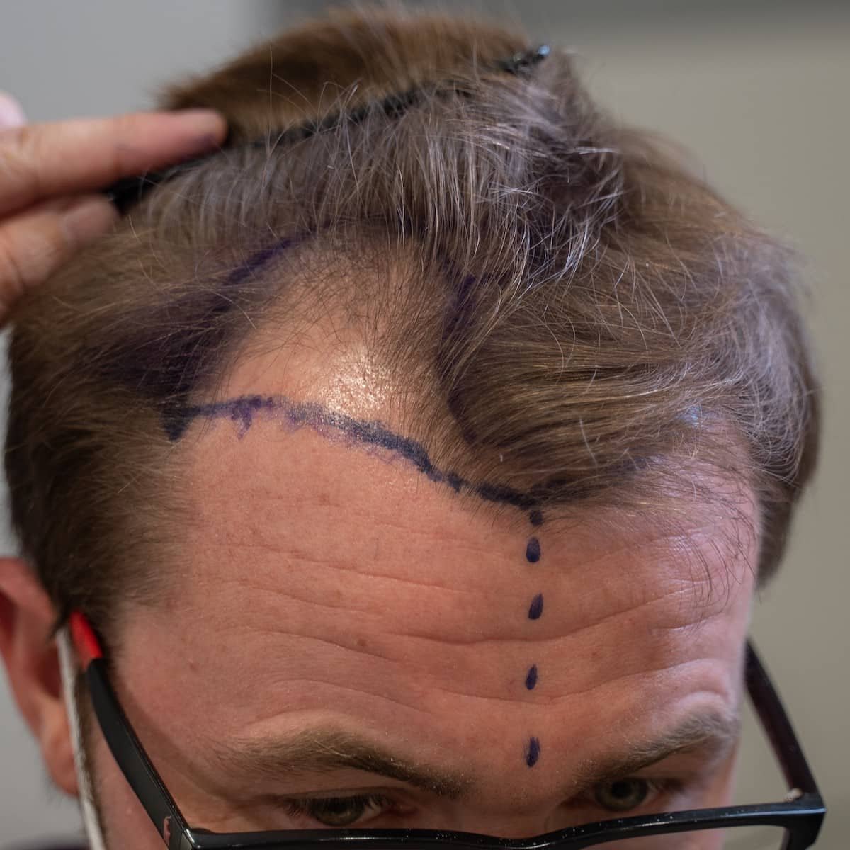 Beard Transplant at Yesilkoy Clinic