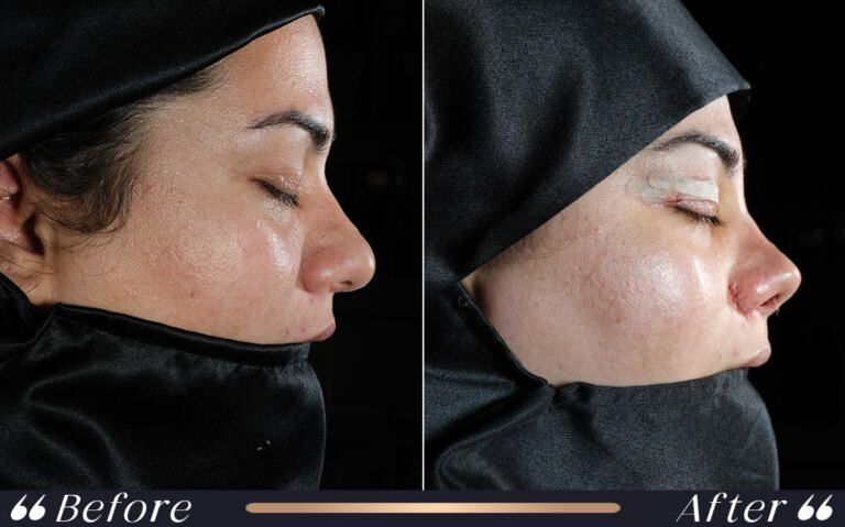 ethnic_rhinoplasty_10