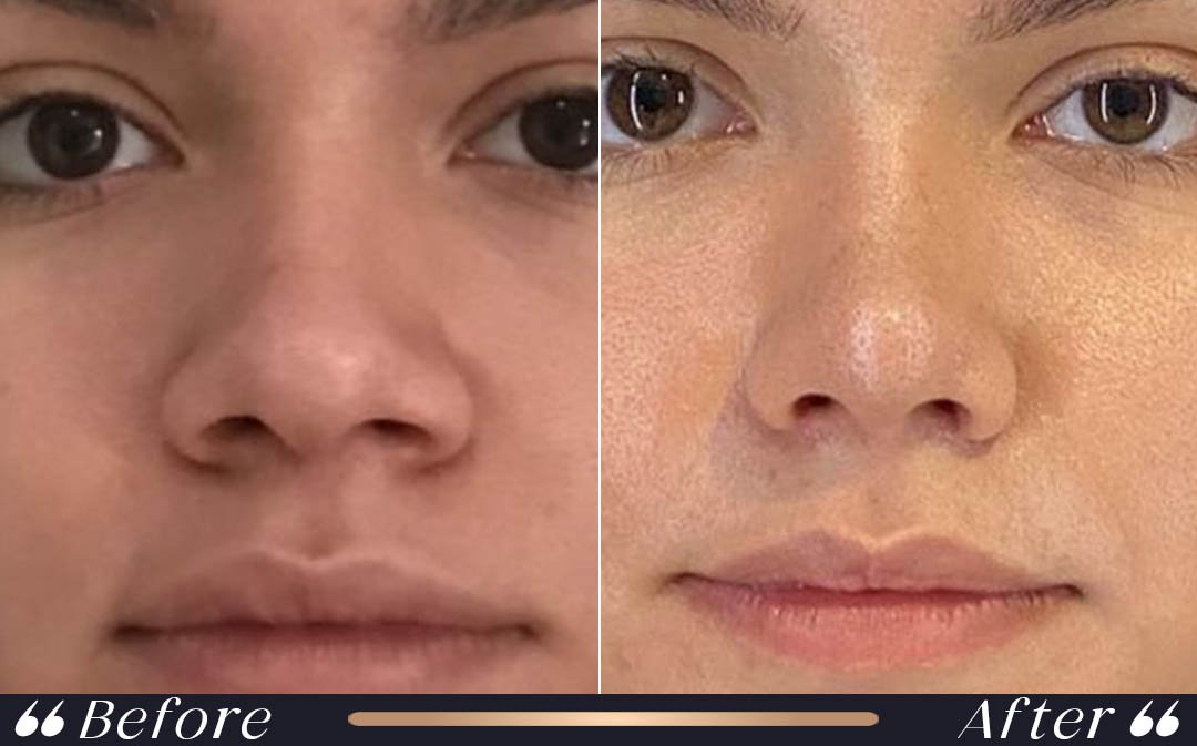 Ethnic Rhinoplasty Turkey ethnic rhinoplasty turkey at Yesilkoy Clinic