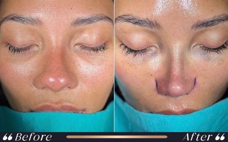 ethnic_rhinoplasty_5