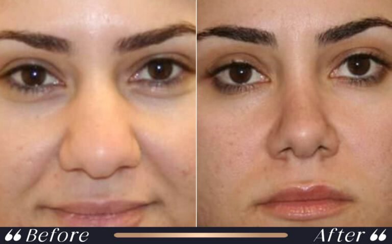 ethnic_rhinoplasty_7