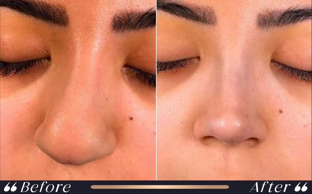 Ethnic Rhinoplasty Individual Planning ethnic rhinoplasty turkey individualized nose surgery planning