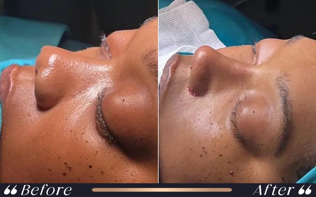 Ethnic Rhinoplasty at Yesilkoy Clinic Istanbul professional ethnic rhinoplasty turkey at Yesilkoy Clinic Istanbul