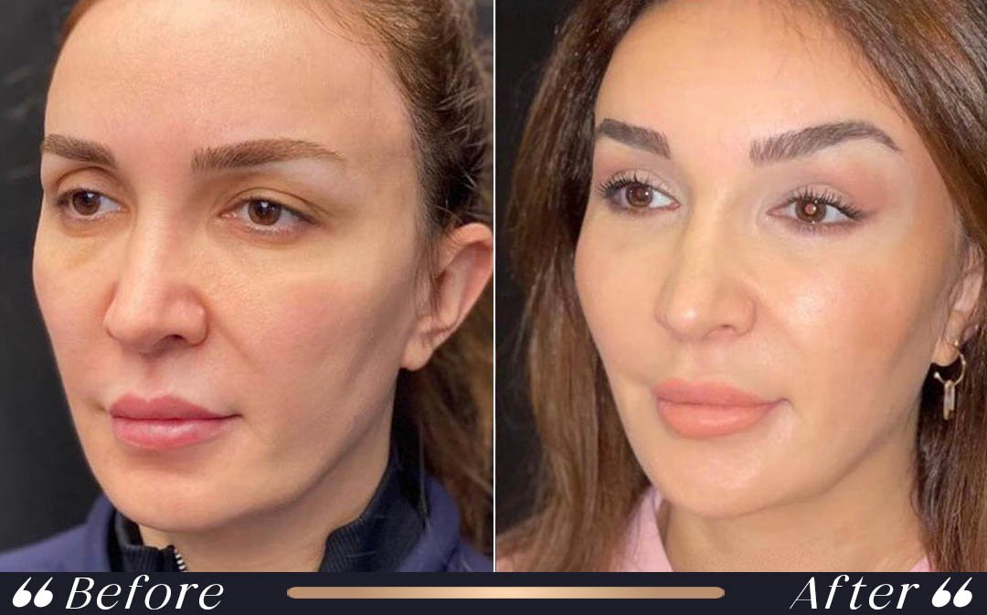 Eyebrow Lift Before and After