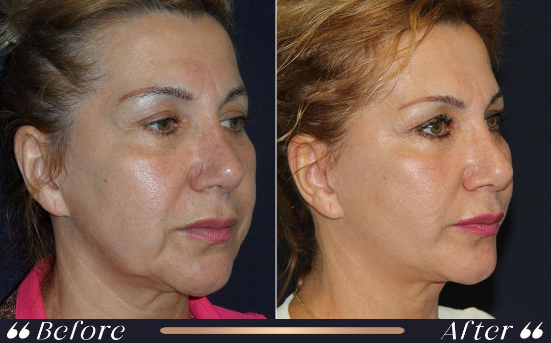 Facial Aesthetics consultation at Yesilkoy Clinic