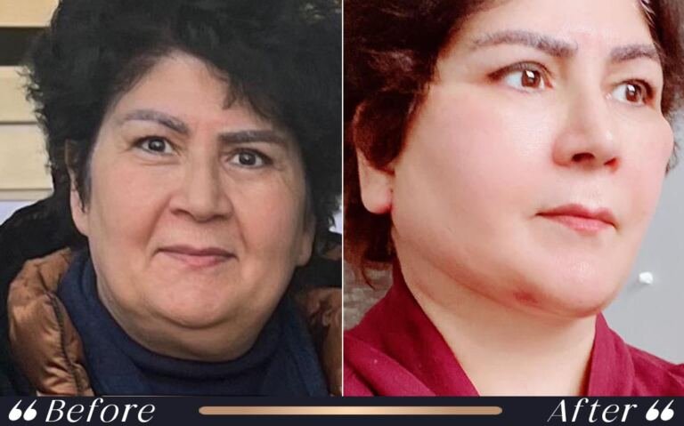 face_and_neck_10
