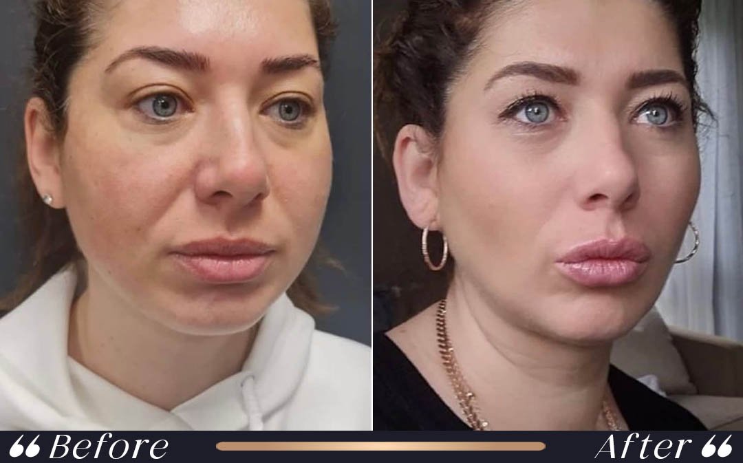 Mini Facelift at Yesilkoy Clinic