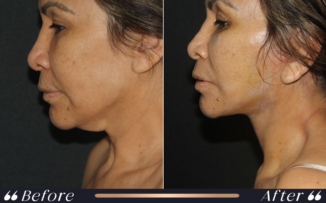 Facelift turkey cost facial rejuvenation and neck contouring