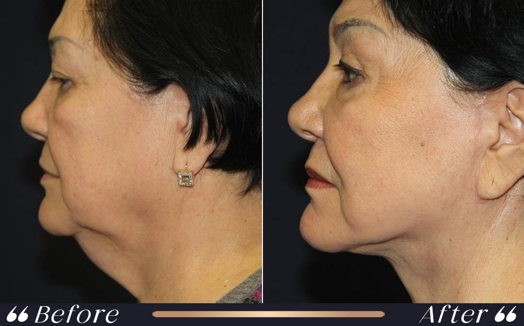 Facelift at Yesilkoy Clinic