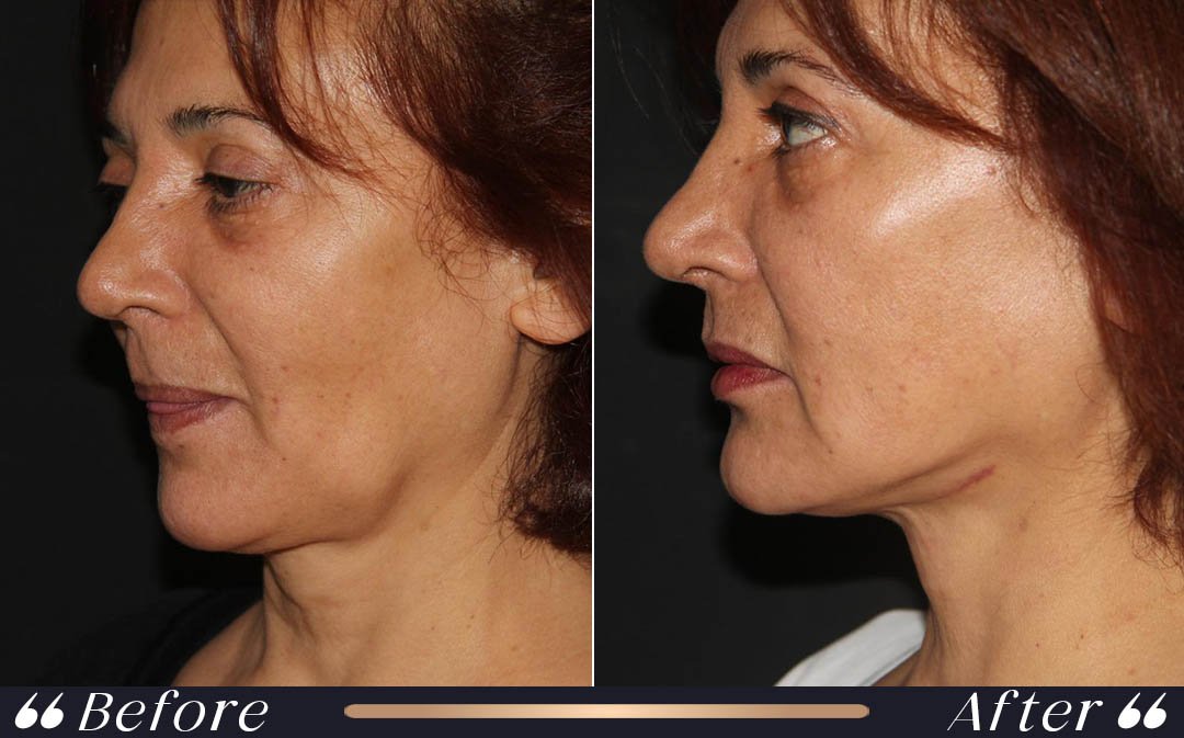 Facelift at Yesilkoy Clinic