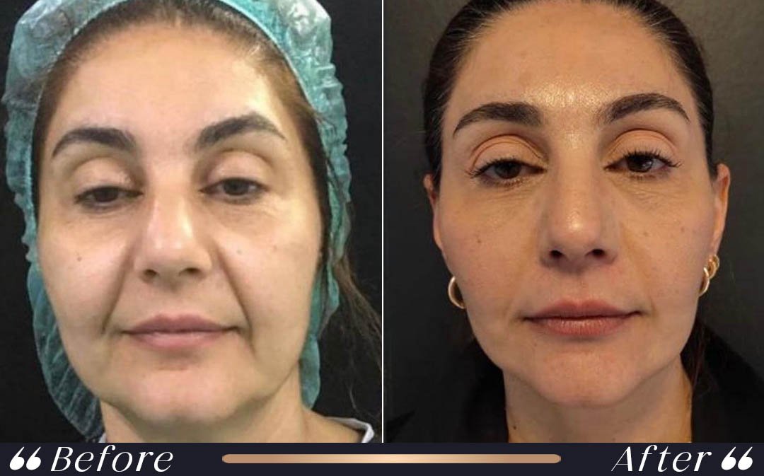Facelift at Yesilkoy Clinic