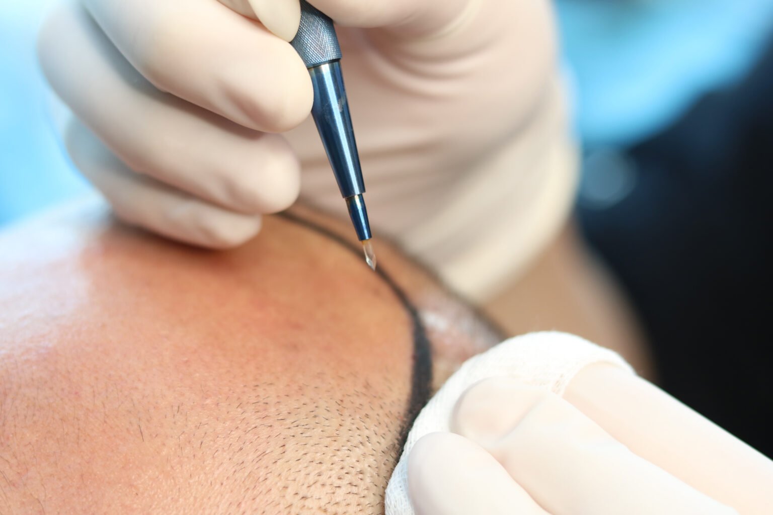 Beard Transplant at Yesilkoy Clinic