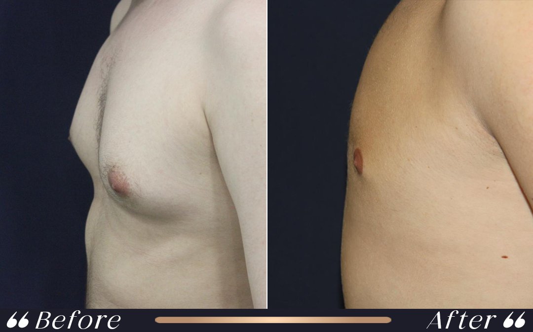 Gynecomastia Surgery at Yesilkoy Clinic