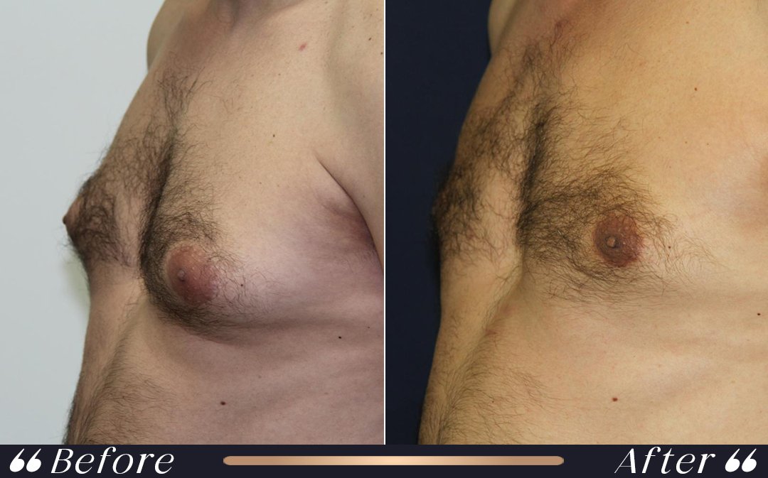 Gynecomastia Surgery at Yesilkoy Clinic
