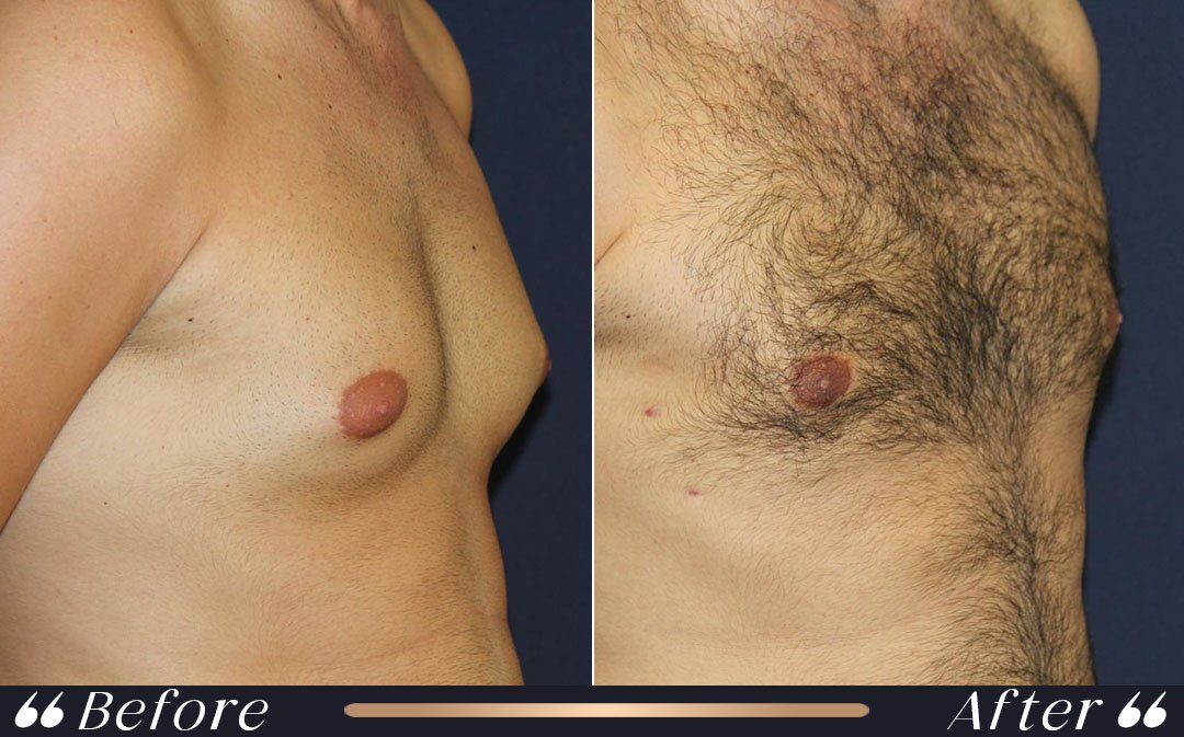 Male Breast Reduction and Follow-Up male breast reduction turkey postoperative planning