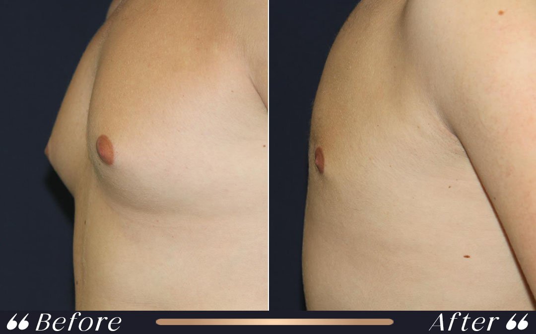 Gynecomastia Surgery at Yesilkoy Clinic
