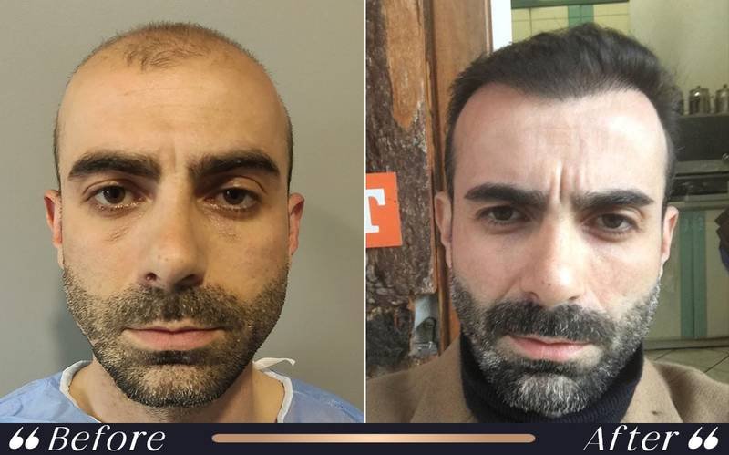 Hair transplant recovery timeline at Yeşilköy Clinic Turkey