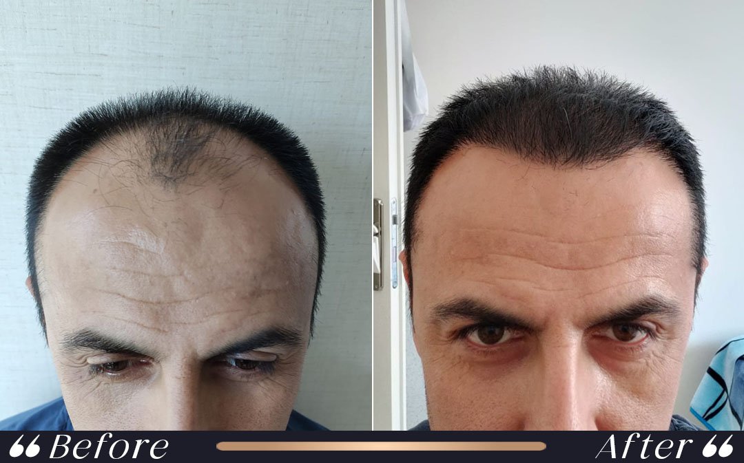 Hair transplant recovery shedding phase after transplantation