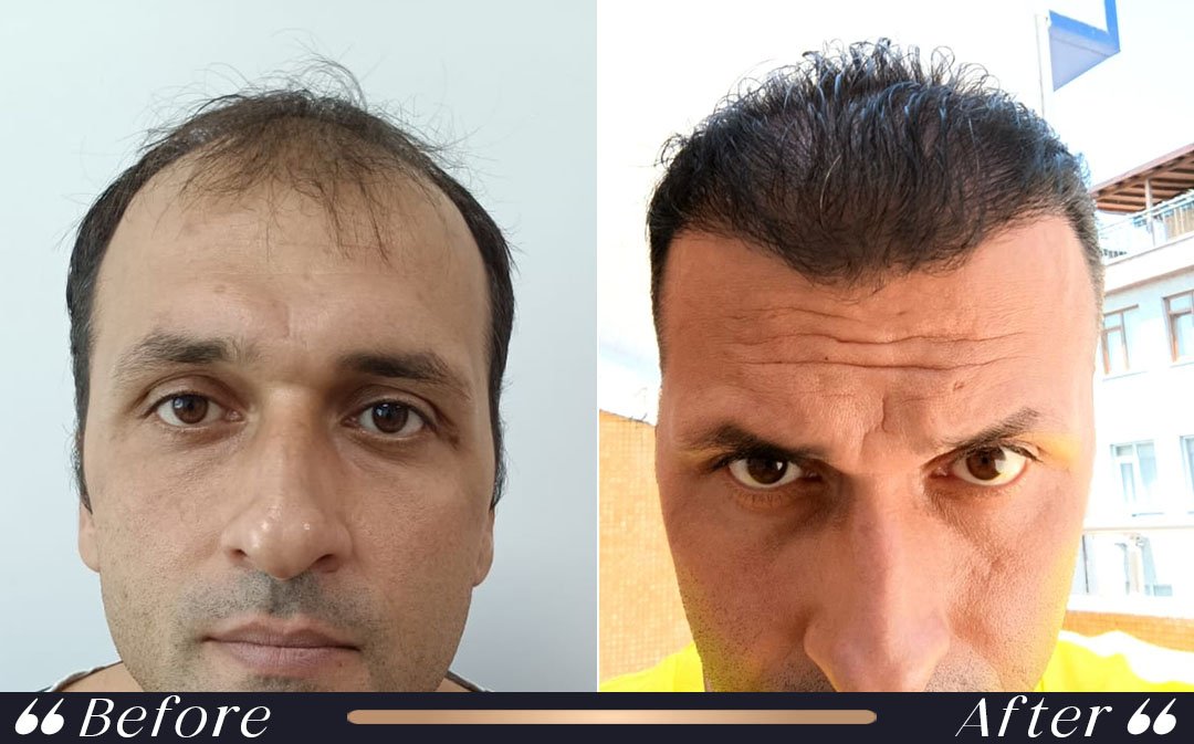 Hair transplant recovery final results after 12 to 18 months