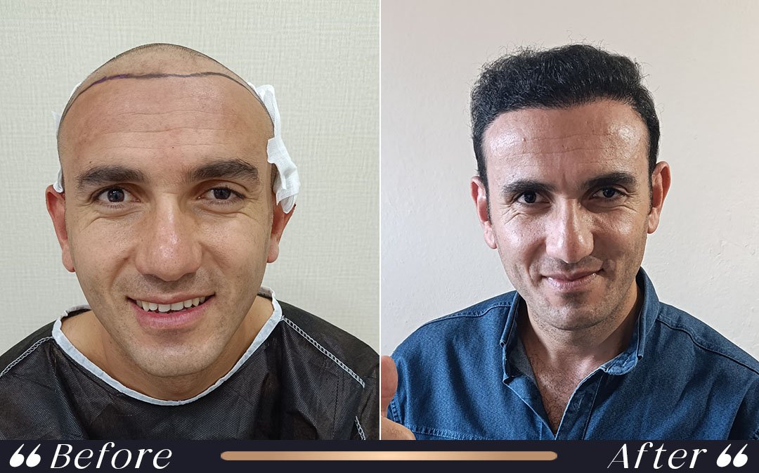 Hair Transplant Recovery Before Flying hair transplant recovery and flying after treatment