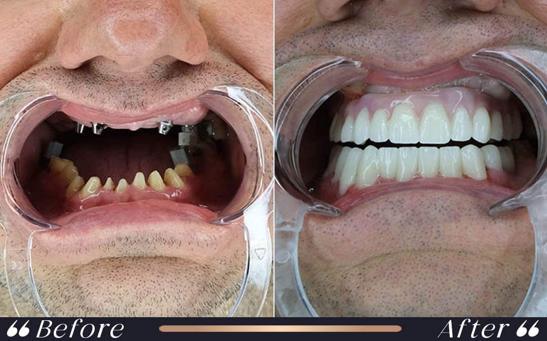 Dental implants Turkey cost 2026 at Yeşilköy Clinic Istanbul