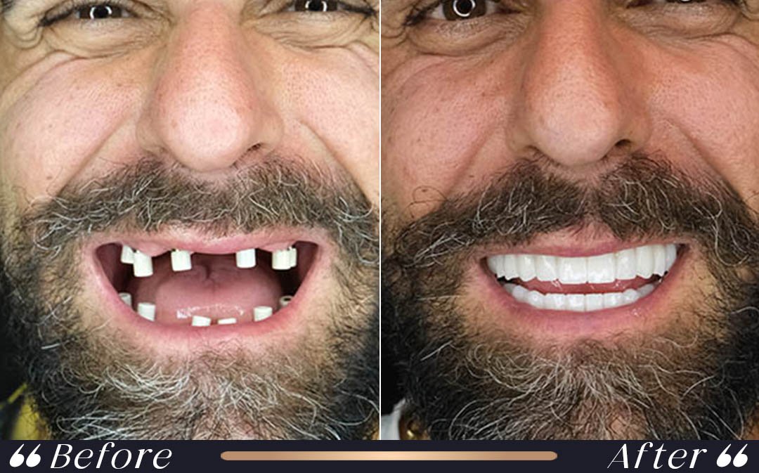 Dental implants Turkey cost single tooth implant treatment