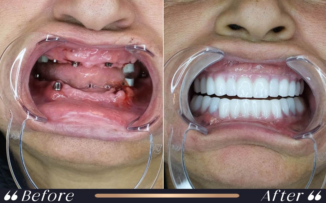 Dental implants Turkey cost full mouth implant treatment in Istanbul
