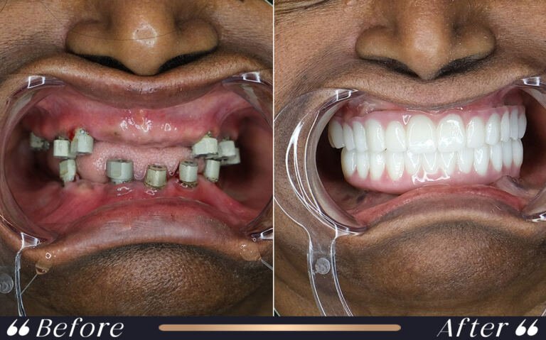 implant_16
