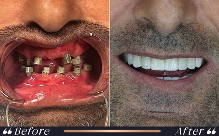 implant_9
