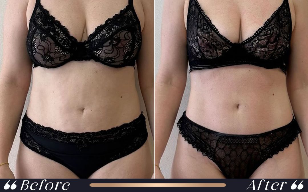 J Plasma Before and After