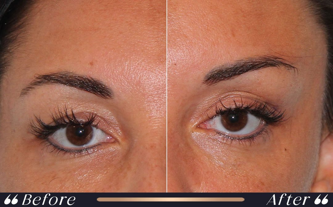 Brow Lift Before and After