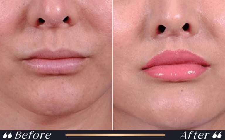liplift