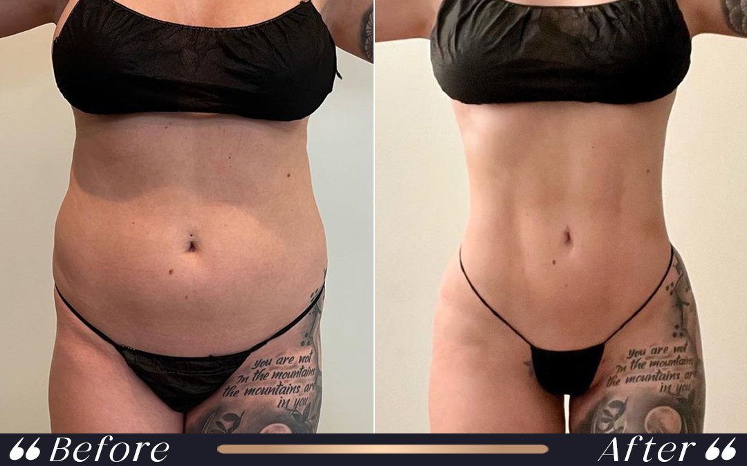 Brazilian Butt Lift BBL at Yesilkoy Clinic