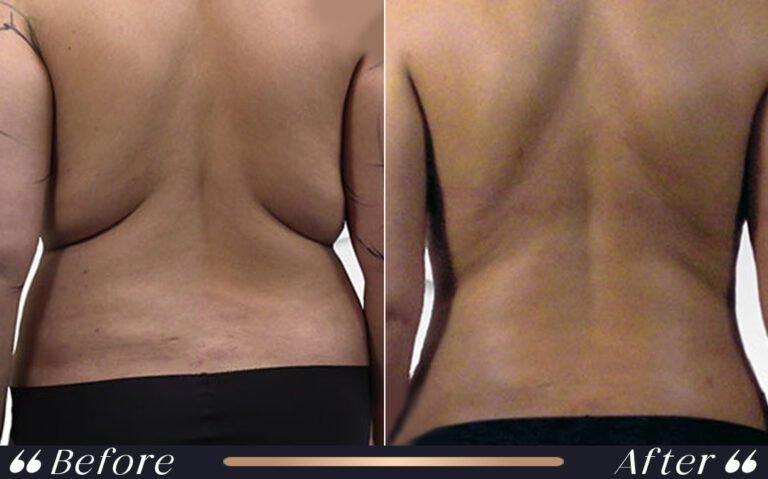 liposuction