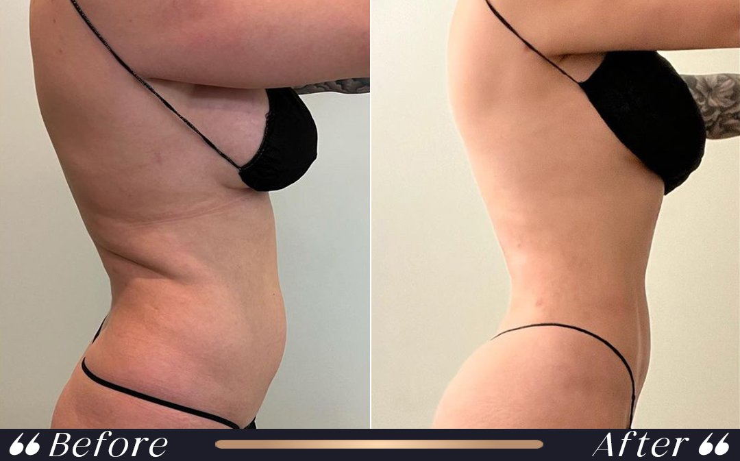 Liposuction at Yesilkoy Clinic